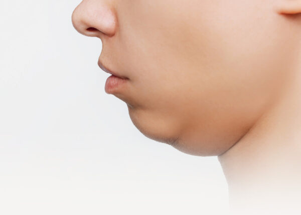 Double Chin Removal