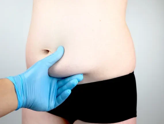 Tummy Tuck (Abdominoplasty)