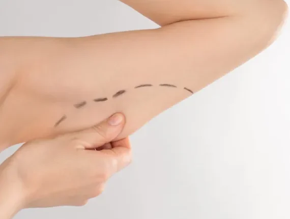 Brachioplasty (Arm Lift)