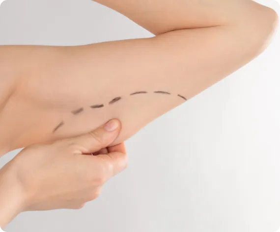 Brachioplasty (Arm Lift)