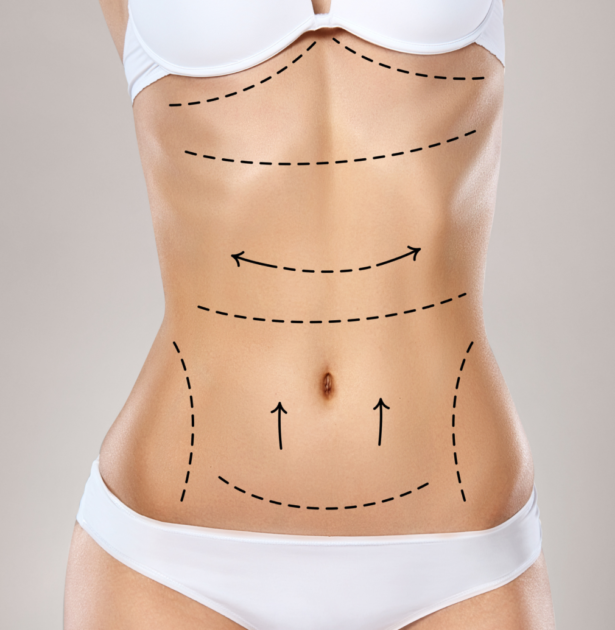 Liposuction vs. Tummy Tuck: Which Is Best for You?
